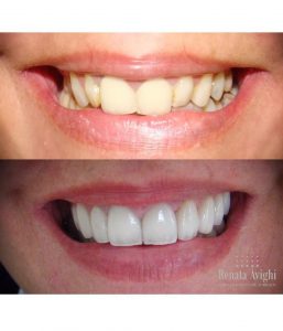 dente antes e depois da lente de contato. mudança no formato cor e alinhamento