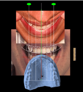 tecnologia digital na odontologia - planejamento de sorriso 3D