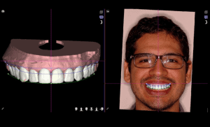 planejamento de design de sorriso - imagem digital