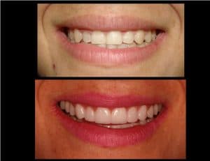 Antes e depois mantendo a naturalidade dos dentes