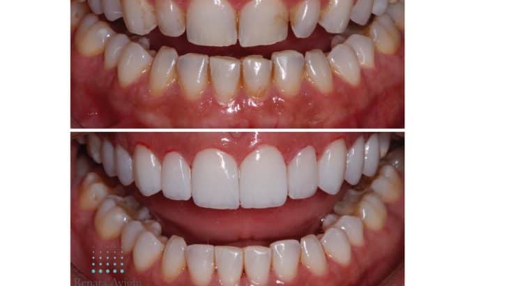 Sorriso Dentista Piracicaba